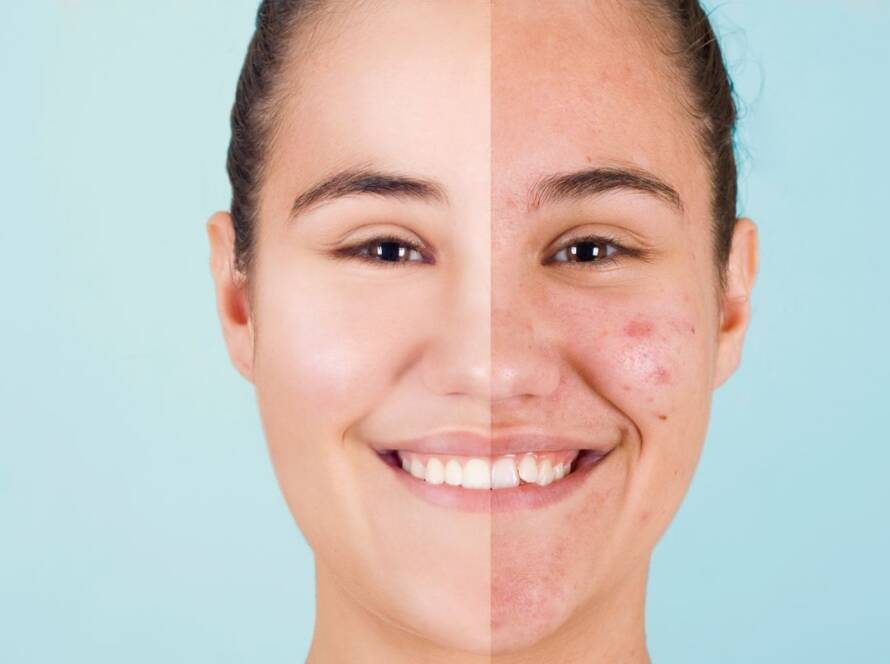 Does saltwater help with acne