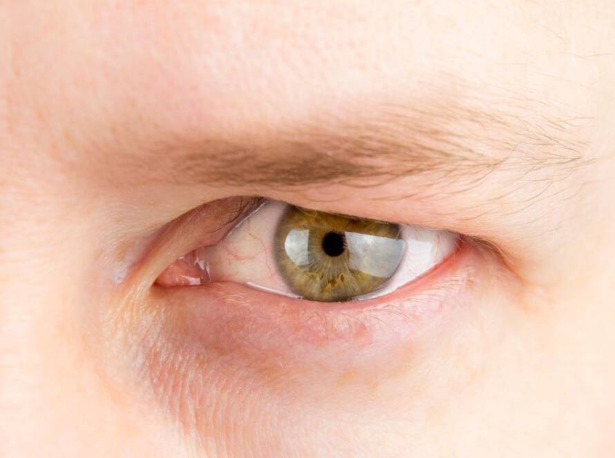 What's Causing Droopy Eyes and How To Treat Them